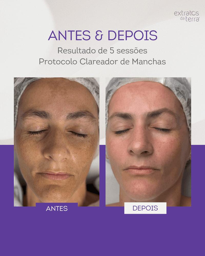 5287-Post-2_Antes-e-Depois_Clareamento-de-Manchas_9662025